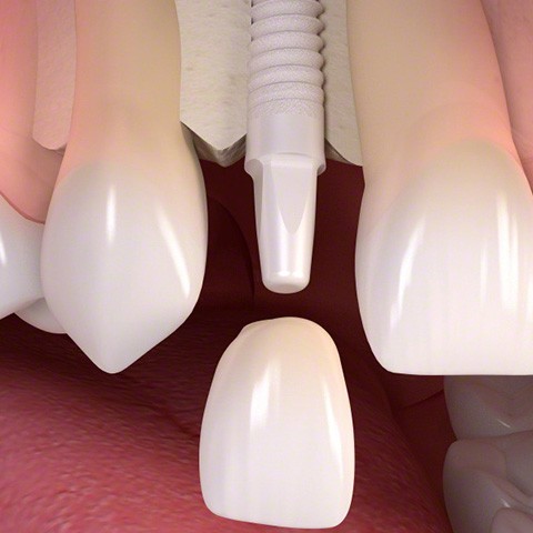 implantat implantat
